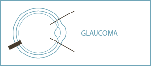 img-cigugia-glaucoma